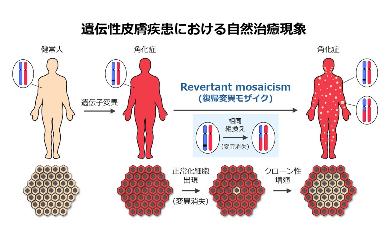 遺伝性皮膚疾患チーム（宮内） – 北海道大学 大学院医学研究院 皮膚 